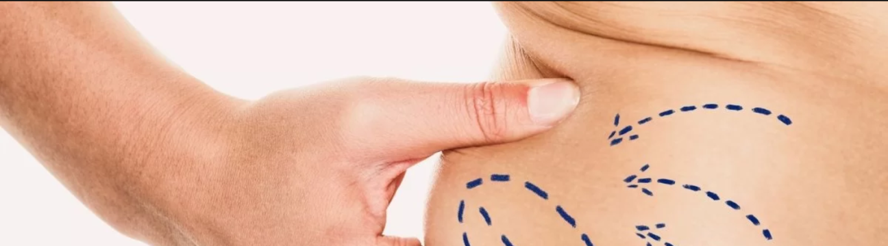 Liposuction Surgery